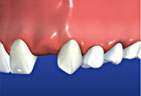 Missing tooth needing a bridge Bridge