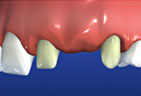 Preparing adjacent teeth by eliminating tooth structure Bridge Preparation Step 2