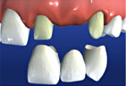 The bridge being cemented to the prepared teeth Bridge Preparation Step 3