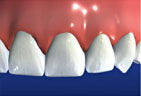 Bridge restoring the natural beauty of the teeth Bridge Preparation Final Step